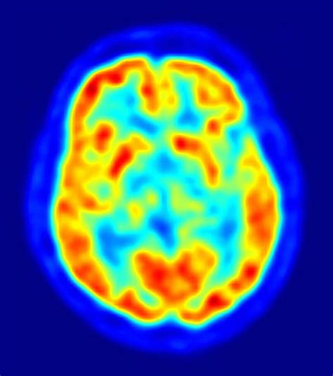 PET Scans Peer into Minimally Conscious Mind - Neuroscience News