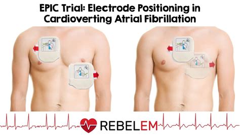 EPIC Trial: Electrode Positioning in Cardioverting Atrial Fibrillation ...