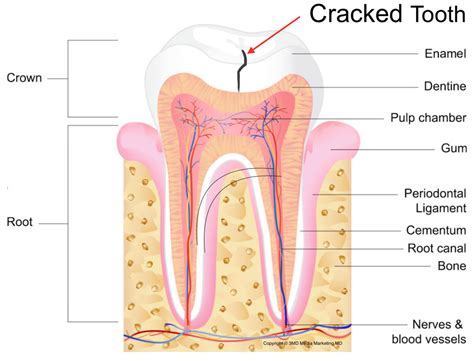 Cracked Teeth - Southlake Endodontics