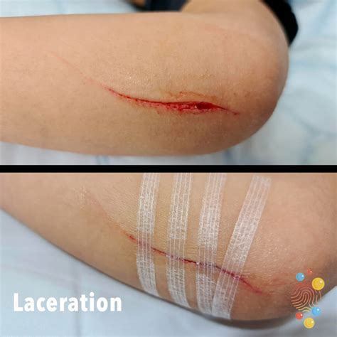 Laceration Wound