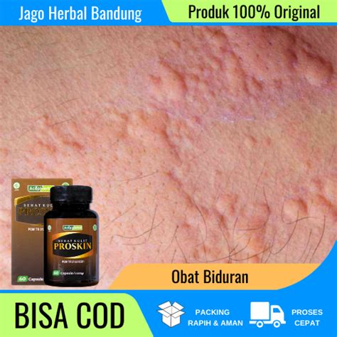 Jual Obat Biduran, Obat Biduran Alergi, Obat Biduran Apotek, Obat ...