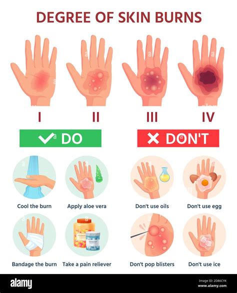 Burns degree. First aid for burn wound. Fire damage to skin ...