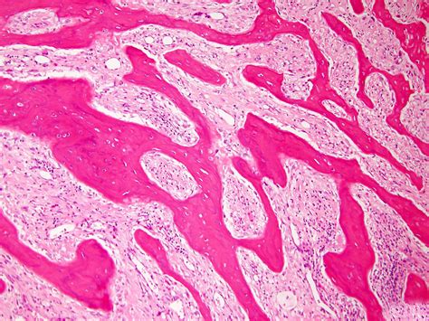 Osteosarcoma Histology