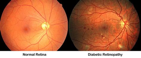 What Is Included In A Diabetic Eye Exam - DiabetesWalls