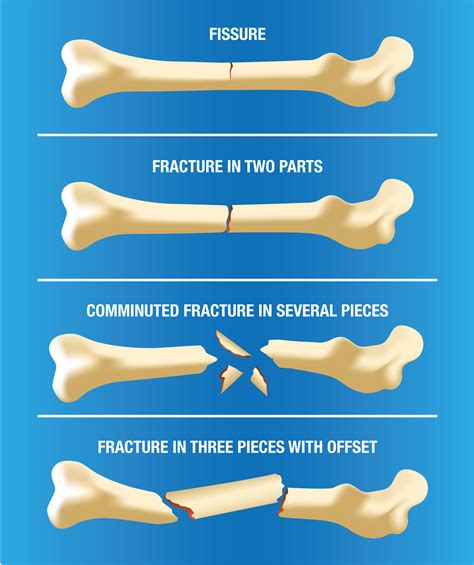 Different Types Of Fractures