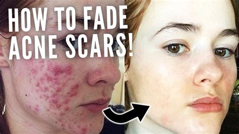 HOW TO FADE ACNE SCARS - YouTube