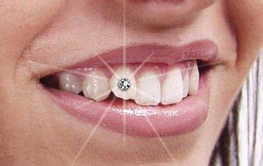 DIAMONDS ON TEETH AHMEDABAD, TOOTH JWELLERY, TOOTH CRYSTALS LAMINATES ...