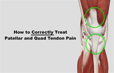 Fixing Patellar & Quad Tendon Pain (2022)