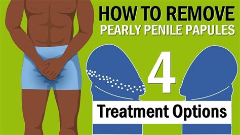 How to Remove Pearly Penile Papules - 4 Treatment Options - YouTube