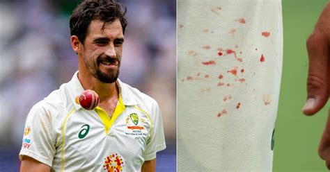 Mitchell Starc finger injury: Mitch Starc finger blood photos from ...