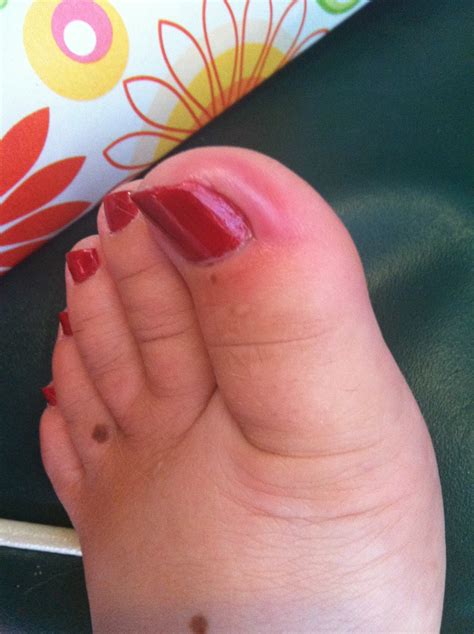 Daily Diabetic: Toe infected, again...