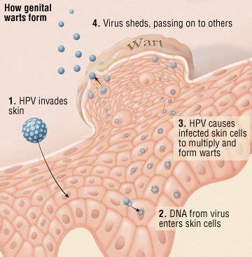 Genital Warts Guide: Causes, Symptoms and Treatment Options