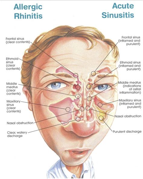 Sinusitis . Sinus anatomy #HeadachesYouShouldWorryAbout | Allergic ...