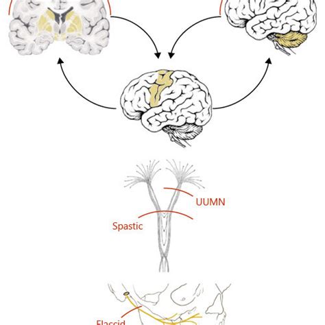 The different types of dysarthria according to the location of ...