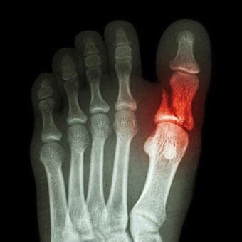 Broken Toe: Treatment, Symptoms, What to Do & Healing Time