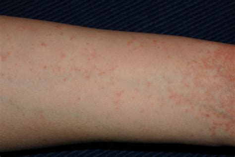 Scabies in Children | The Pediatric Center