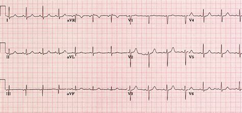 12 lead ecg interpretation quiz