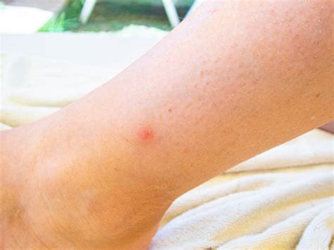 Bug Bite Insect Human Skin Allergy Stock Photos, Pictures & Royalty ...