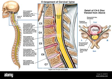 Spinal Cord Injury -Herniated Intervertebral Disk Stock Photo: 7712652 ...