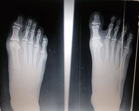 Why is Proper Toe Alignment Important & Best Bunion Treatment to Help