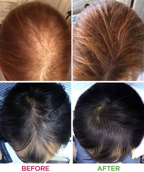 Red Laser Light For Hair Growth: What Is It And Does It Work? - Woman ...