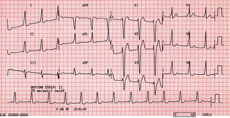 B27. Wolff Parkinson White (WPW) Syndrome Type B