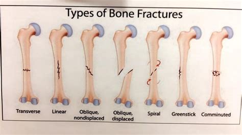 Types of Bone Fractures guide : coolguides | Bone fracture, Types of ...