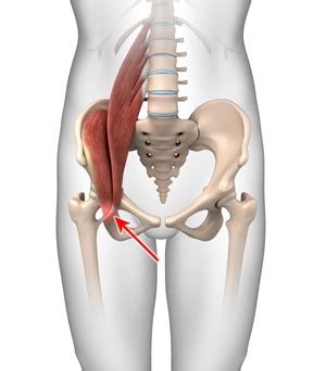 Iliopsoas Tendonitis Irving, TX | Snapping Hip Syndrome Southlake, TX