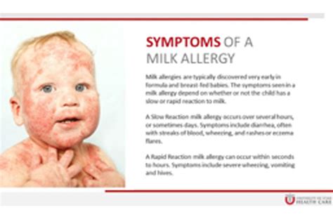 Milk allergy in children