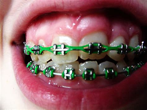 Questions about your Braces in Tampa, FL - Orthodontics in Tampa FL ...