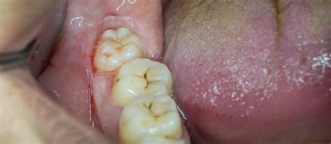 Early Stage Wisdom Tooth Infection - A Comprehensive Guide