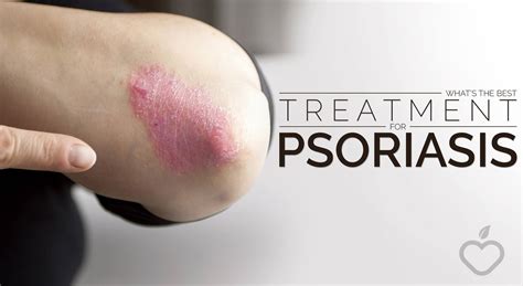 What’s The Best Treatment For Psoriasis – Positive Health Wellness