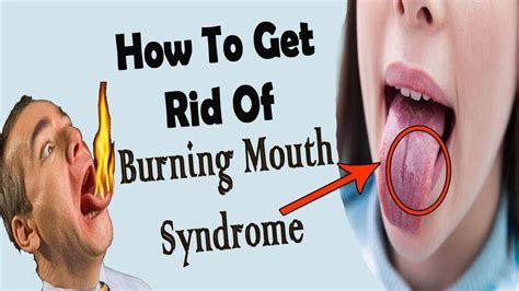 How To Get Rid Of Burning Mouth Syndromes || Home Remedies For Burning ...