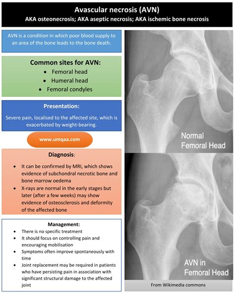 What Is Avascular Necrosis Of The Femoral Head With Pictures | The Best ...