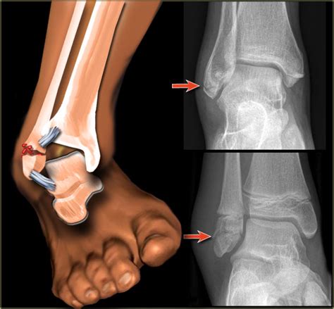 Ankle Fracture Specialist | 🩺Singapore Sports & Orthopaedic Surgeon