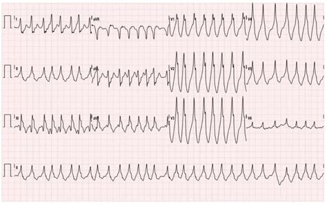 Wolff-Parkinson-White Syndrome: Electrocardiogram - JETem