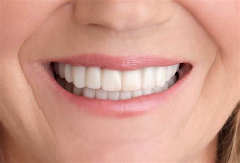 Snap-On Smile - Less-expensive alternative to full mouth reconstruction