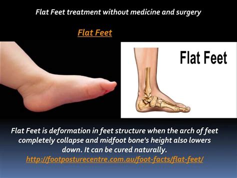 PPT - Flat Feet treatment without medicine and surgery PowerPoint ...