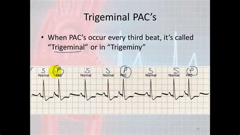 Basic Electrophysiology, part 7 - Atrial Rhythms, part 1, Introduction ...