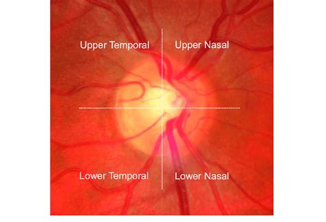 Grading the location of cilioretinal arteries with respect to the ...