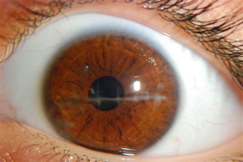 Corneal Abrasion - Corneal Abrasion Treatment