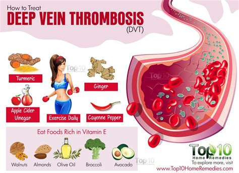 How to Deal with Deep Vein Thrombosis (DVT) | Top 10 Home Remedies ...