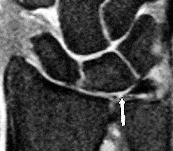 Triangular Fibrocartilage Complex (TFCC) Injury - Hand - Orthobullets