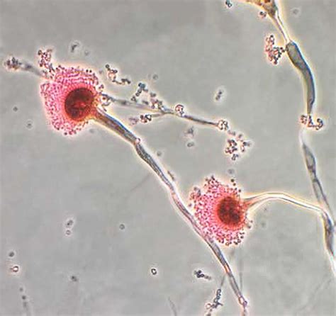 Aspergillus & Aspergillosis - Symptoms, Diagnosis, Treatment