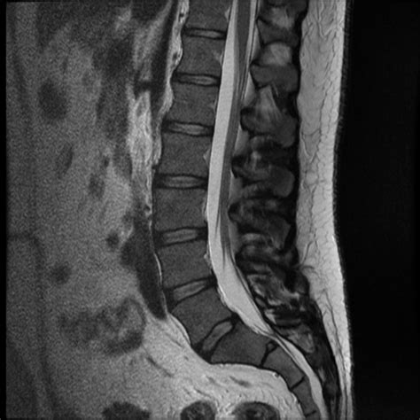 Mri Images Spine