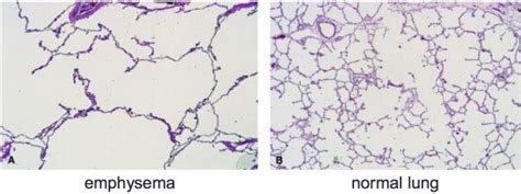 Image result for emphysema histology vs normal | Tapestry, Map, World map