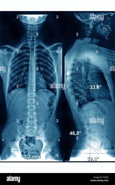 SPINAL COLUMN, X-RAY Stock Photo - Alamy