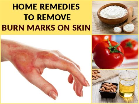 Home Remedies For Skin Burn | Homemade Mask For Burn Marks | How To ...