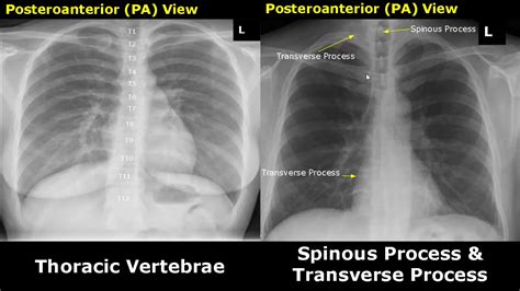 Normal Chest X-Ray Labelled Anatomy PA View | CXR Interpretation | Ribs ...