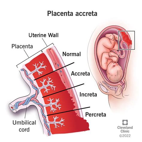 Placenta Accreta: Types, Risks, Causes & Treatment